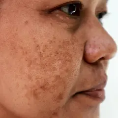 Zbliżenie twarzy kobiety z przebarwieniami. Czy to melasma? Widoczne plamy na skórze.