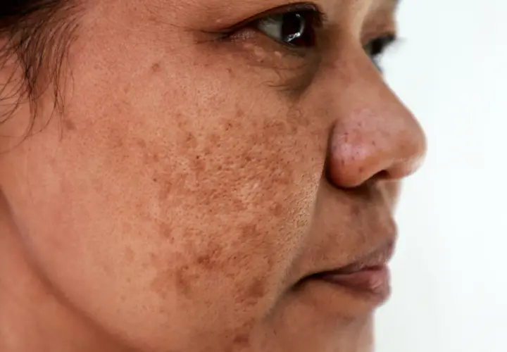Zbliżenie twarzy kobiety z przebarwieniami. Czy to melasma? Widoczne plamy na skórze.