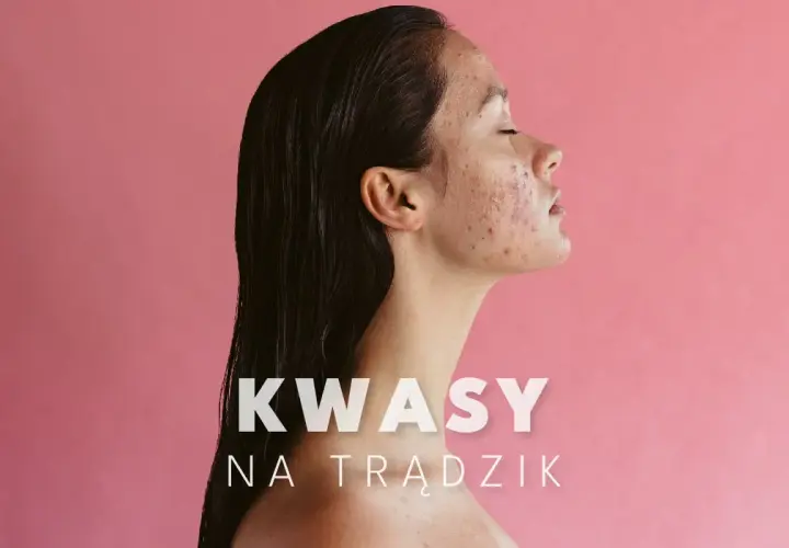 Kobieta z trądzikiem na twarzy, która może skorzystać z kuracji kwasami na trądzik.