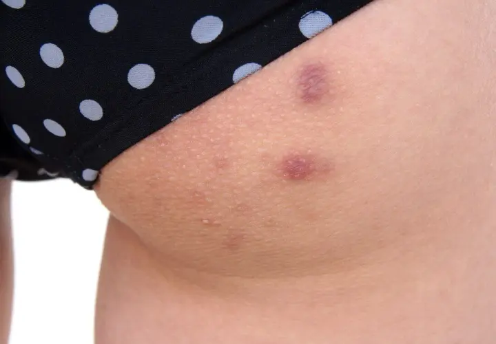Skóra na udach z kropkowanymi majtkami. Widoczne zaczerwienione pryszcze na udach i drobne krostki.