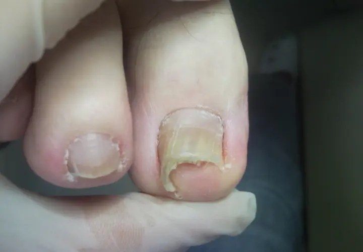 Zniszczone paznokcie u nóg, wymagające profesjonalnego pedicure.