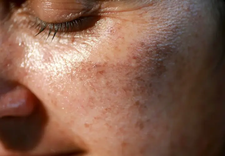 Zbliżenie na twarz z widocznymi przebarwieniami i jaśniejszymi plamami, sugerującymi vitiligo. Skóra jest lekko błyszcząca.