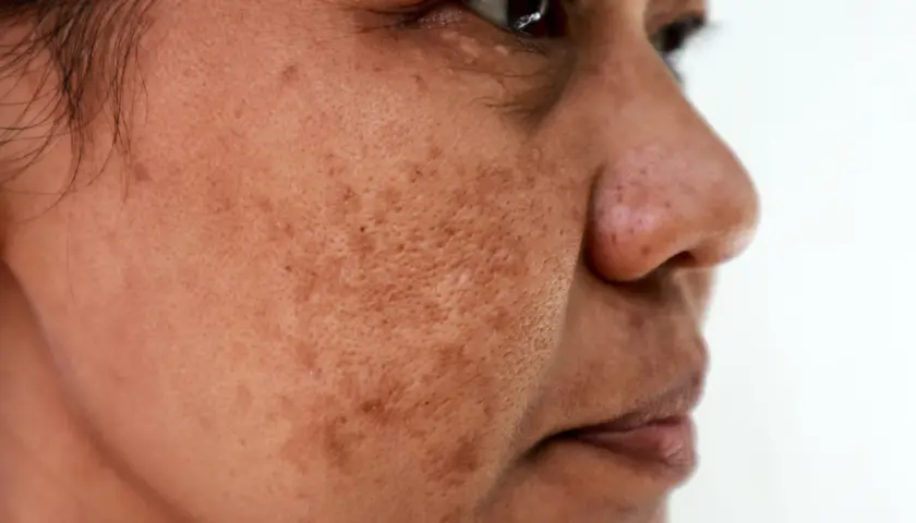 Zbliżenie twarzy kobiety z przebarwieniami. Czy to melasma? Widoczne plamy na skórze.