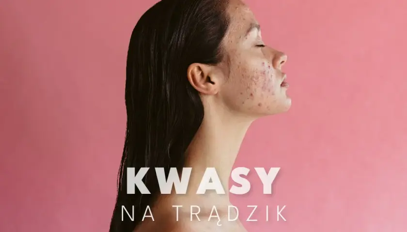 Kobieta z trądzikiem na twarzy, która może skorzystać z kuracji kwasami na trądzik.