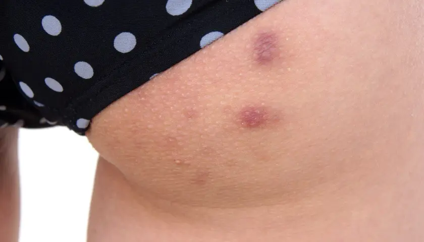 Skóra na udach z kropkowanymi majtkami. Widoczne zaczerwienione pryszcze na udach i drobne krostki.
