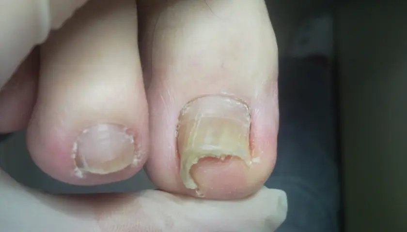 Zniszczone paznokcie u nóg, wymagające profesjonalnego pedicure.