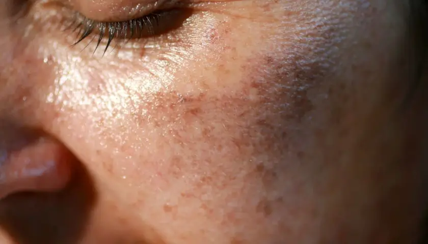 Zbliżenie na twarz z widocznymi przebarwieniami i jaśniejszymi plamami, sugerującymi vitiligo. Skóra jest lekko błyszcząca.