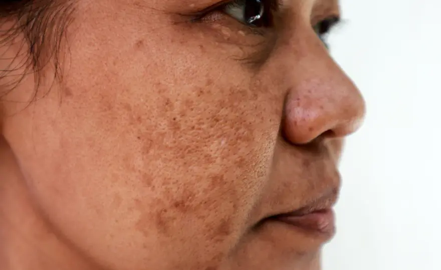 Melasma i ostuda - dlaczego wracają i jak je skutecznie zwalczyć?