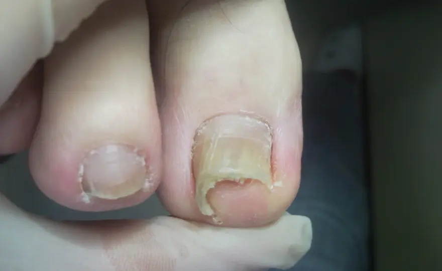 Pedicure paznokci u stóp - Jak uniknąć wrastania i bólu?