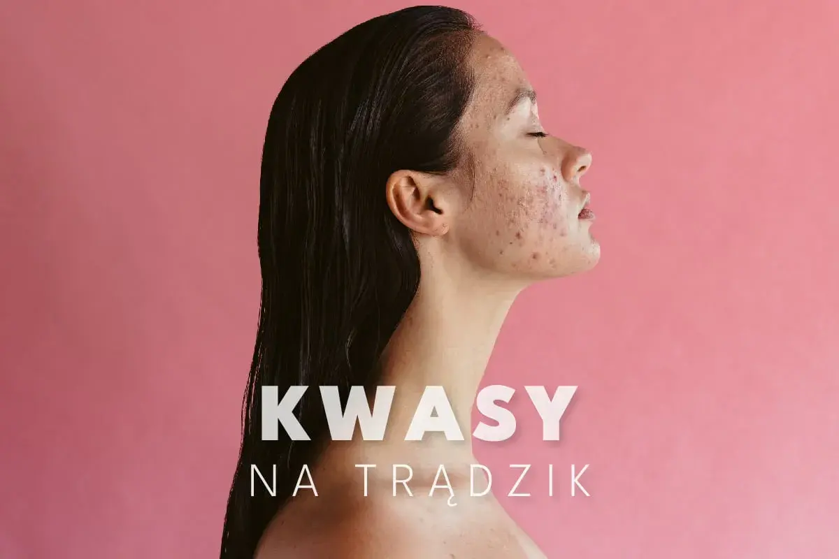 Kobieta z trądzikiem na twarzy, która może skorzystać z kuracji kwasami na trądzik.