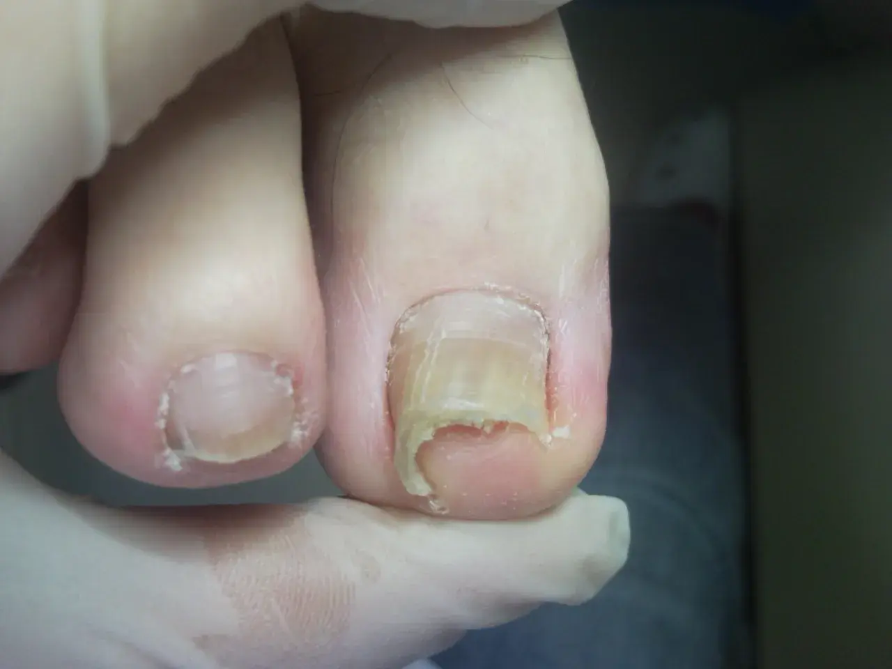 Zniszczone paznokcie u nóg, wymagające profesjonalnego pedicure.
