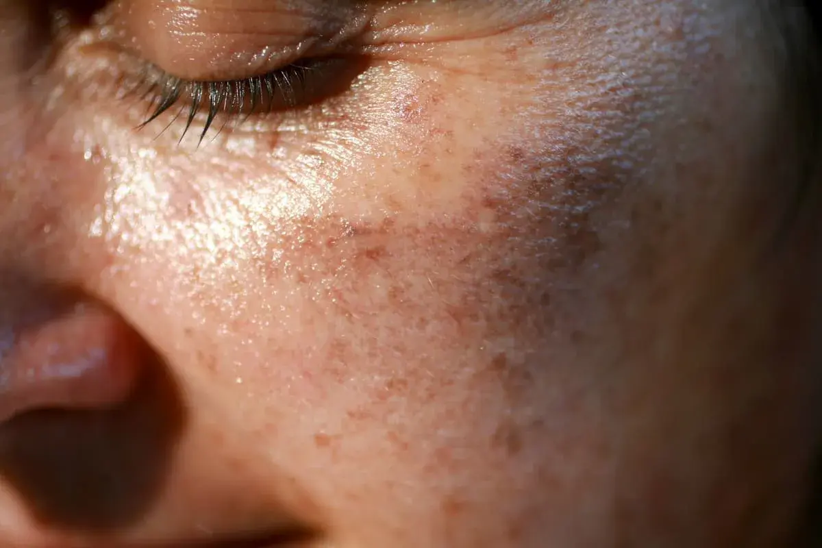 Zbliżenie na twarz z widocznymi przebarwieniami i jaśniejszymi plamami, sugerującymi vitiligo. Skóra jest lekko błyszcząca.