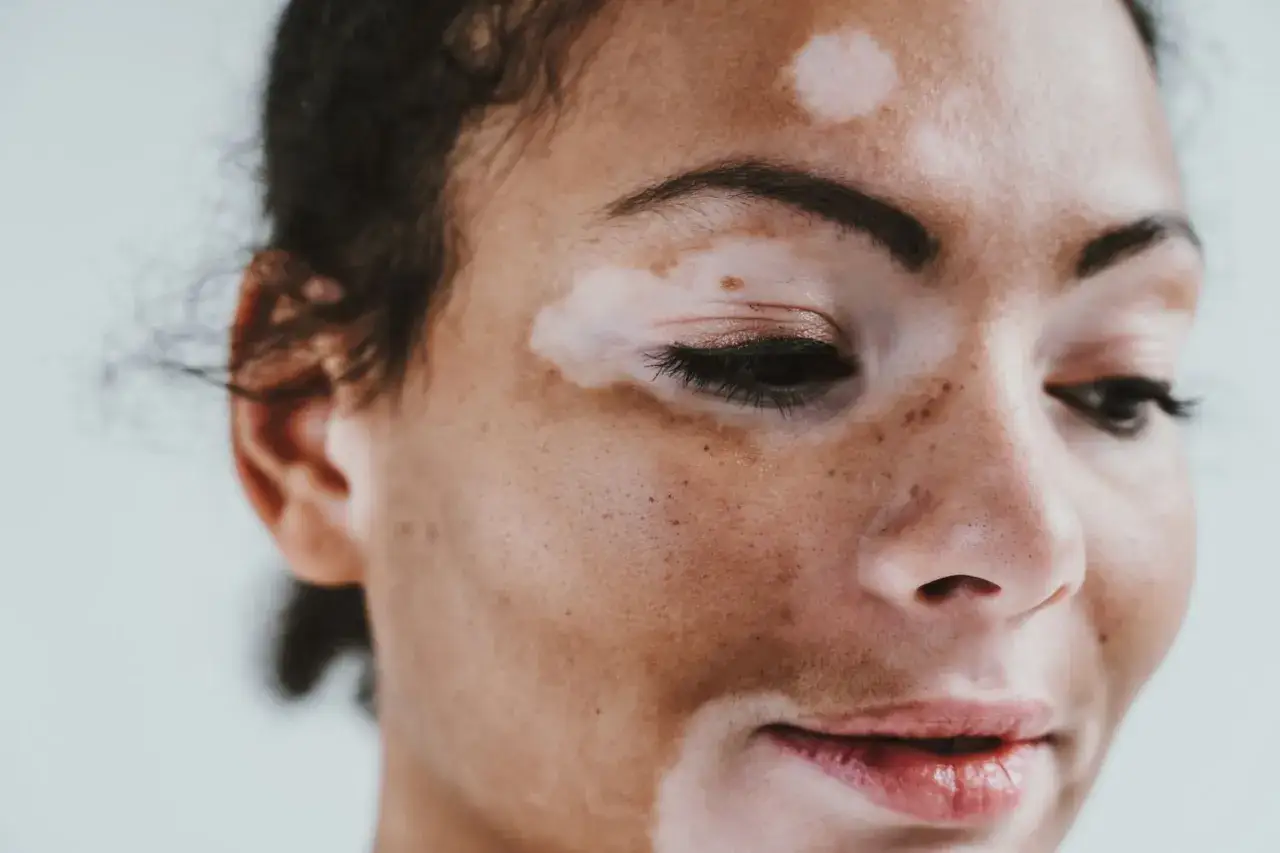Zbliżenie na twarz kobiety z widocznym vitiligo. Jasne plamy kontrastują z jej ciemniejszą karnacją, tworząc unikalny wzór.